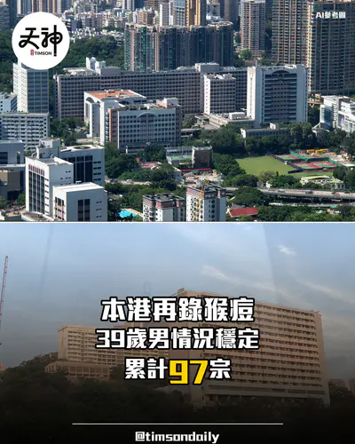 本港再錄猴痘確診 39歲男情況穩定